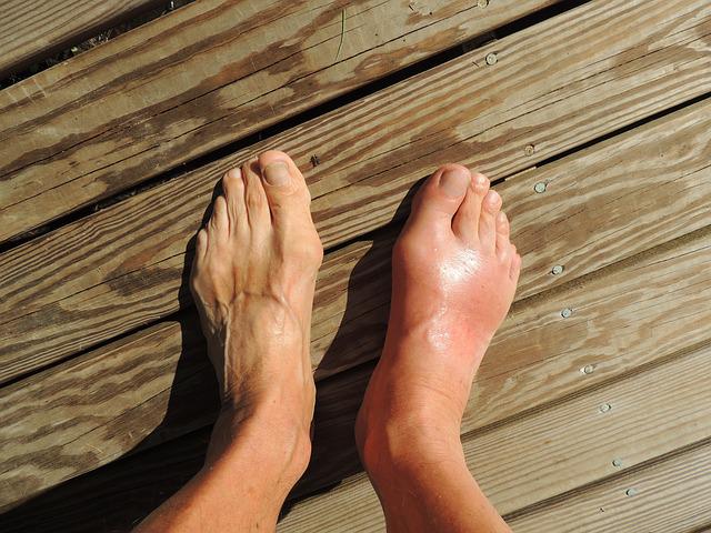 A person’s foot is shown to be very swollen from injury
