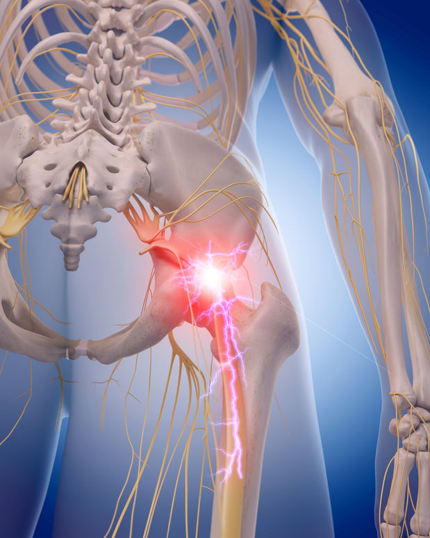 Top 4 Causes of Sciatica